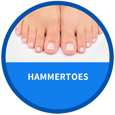 Icon for Hammertoes