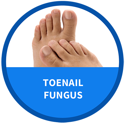 Icon for Toenail Fungus