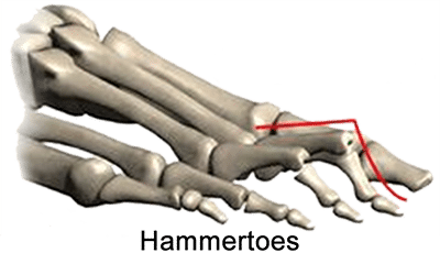 hammertoes illustration hammertoes illustration