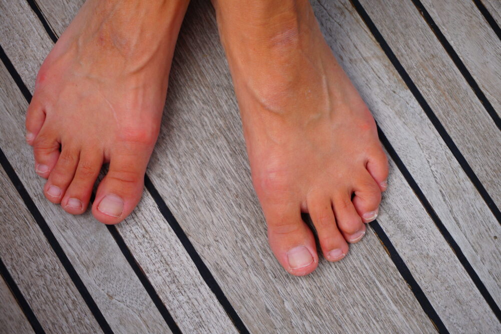 Feet with hammertoes