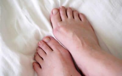 What You Should Know About Bunions