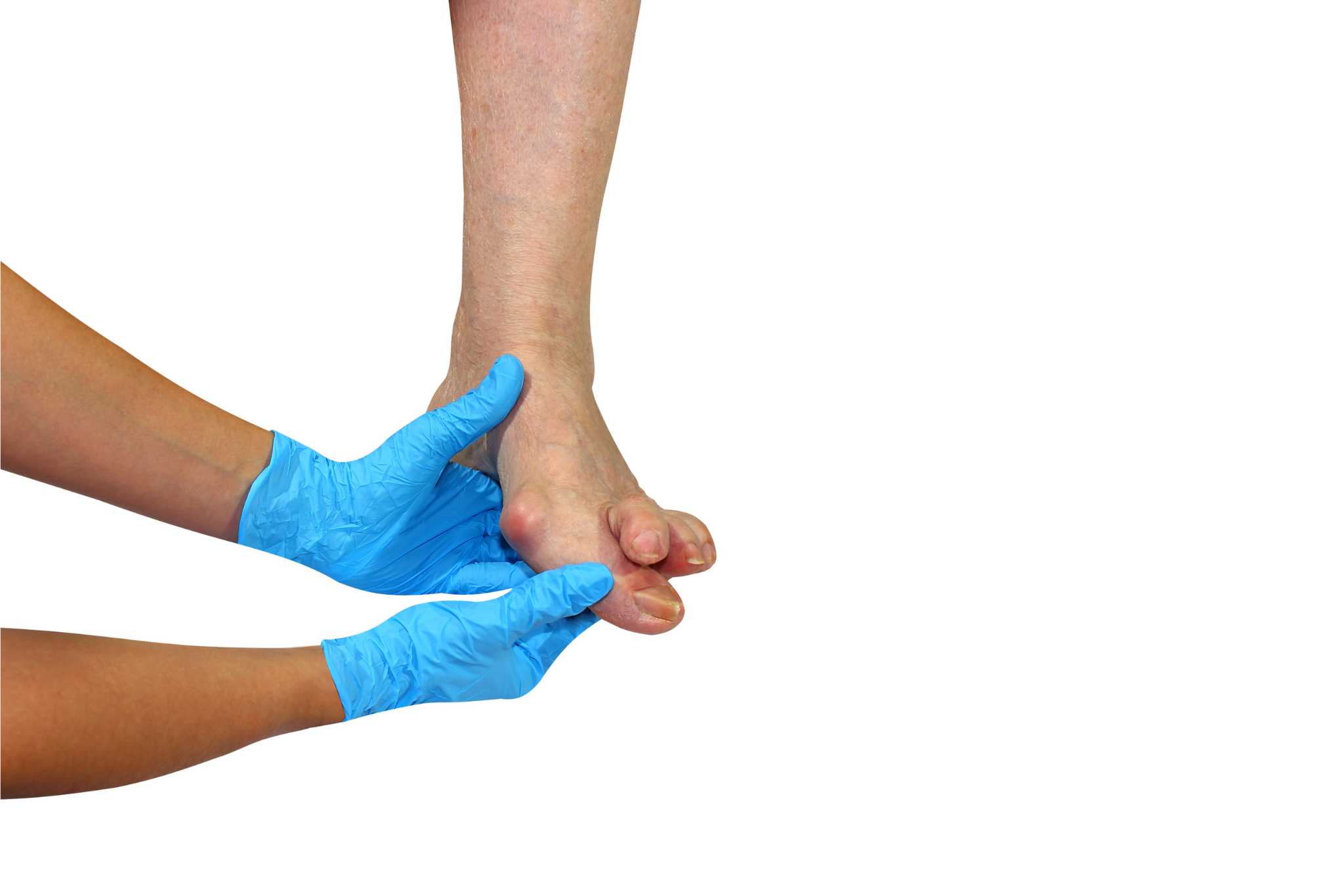hand with gloves touching feet with bunions