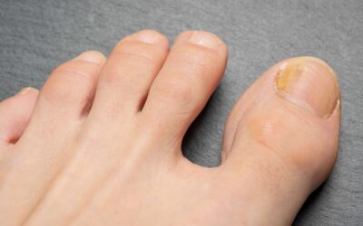 10 Home Remedies for Fungal Toenails